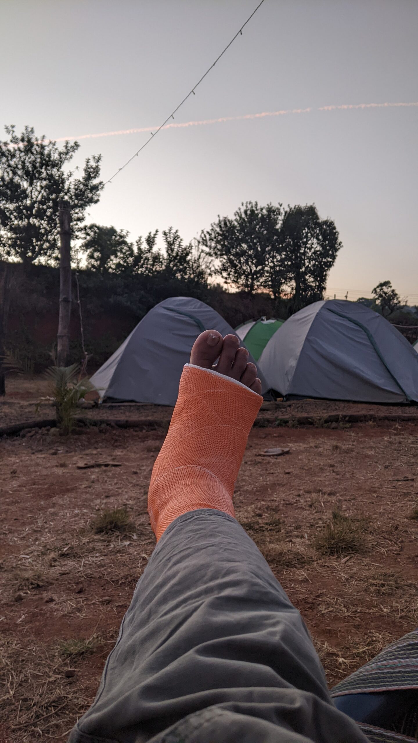 Fractured Foot with Plaster